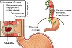 Рак пищевода IV стадии