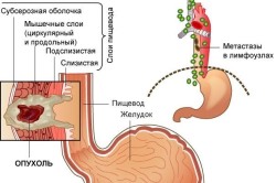 Рак пищевода III стадии